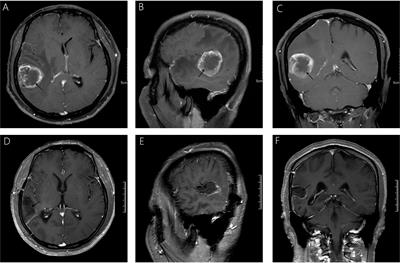 Primary Intracranial Leiomyosarcoma Secondary to Glioblastoma: Case Report and Literature Review